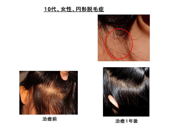 円形脱毛症　病院